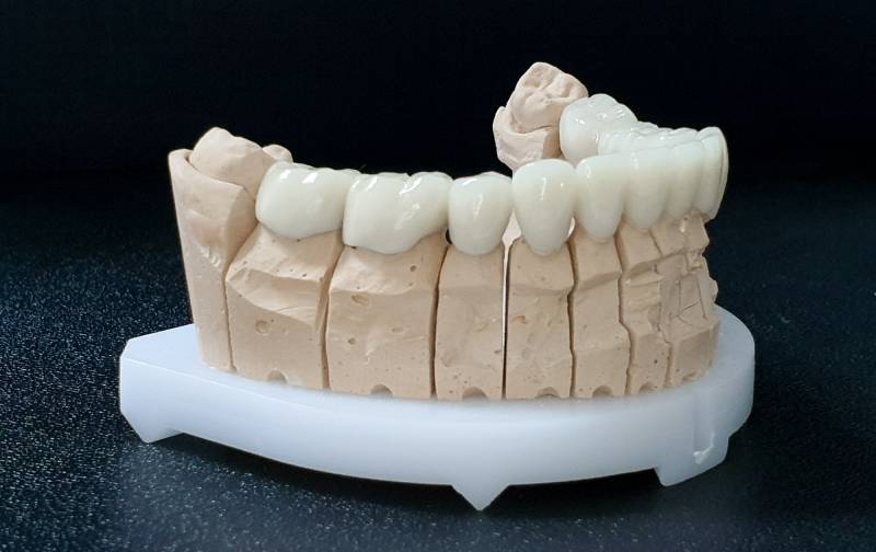 Slika navlaka za zube donje vilice sa desne strane