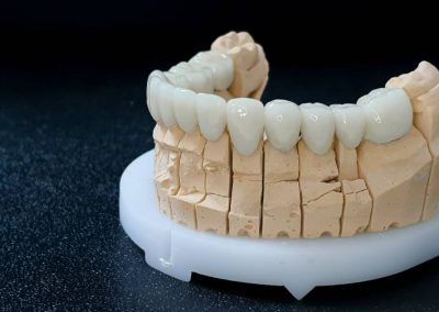 Slika navlaka za zube donje vilice sa leve strane