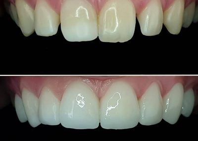 Slika zuba pre i posle keramičkih vinira