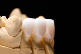 Slika postavlnjenih cementiranih zubnih navlaka
