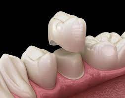 3D ilustracija zubne navlake koja stoji iznad zbrušenog zuba