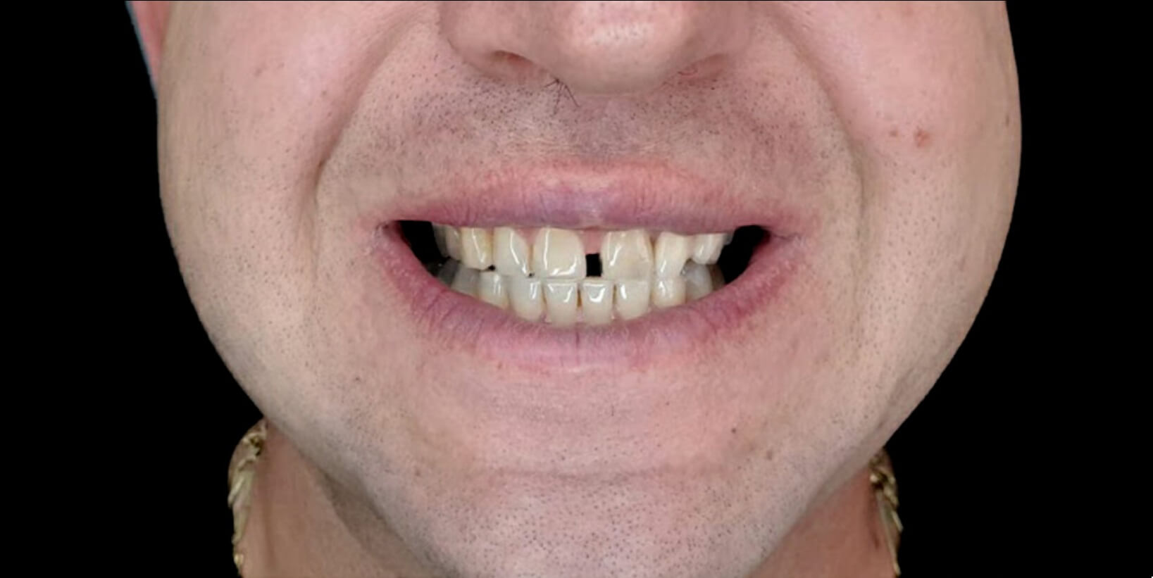 Slika zuba pre keramičkih cirkona