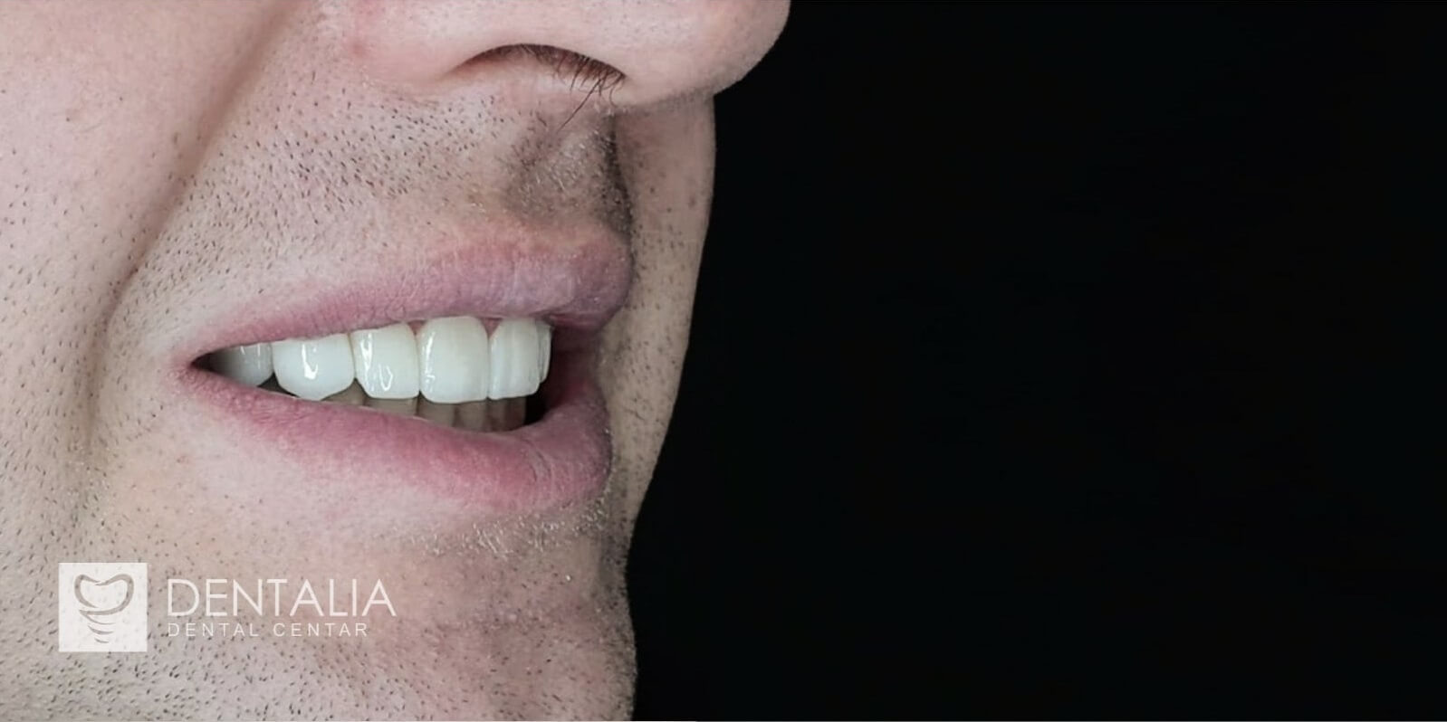 Slika zuba posle keramičkih cirkona