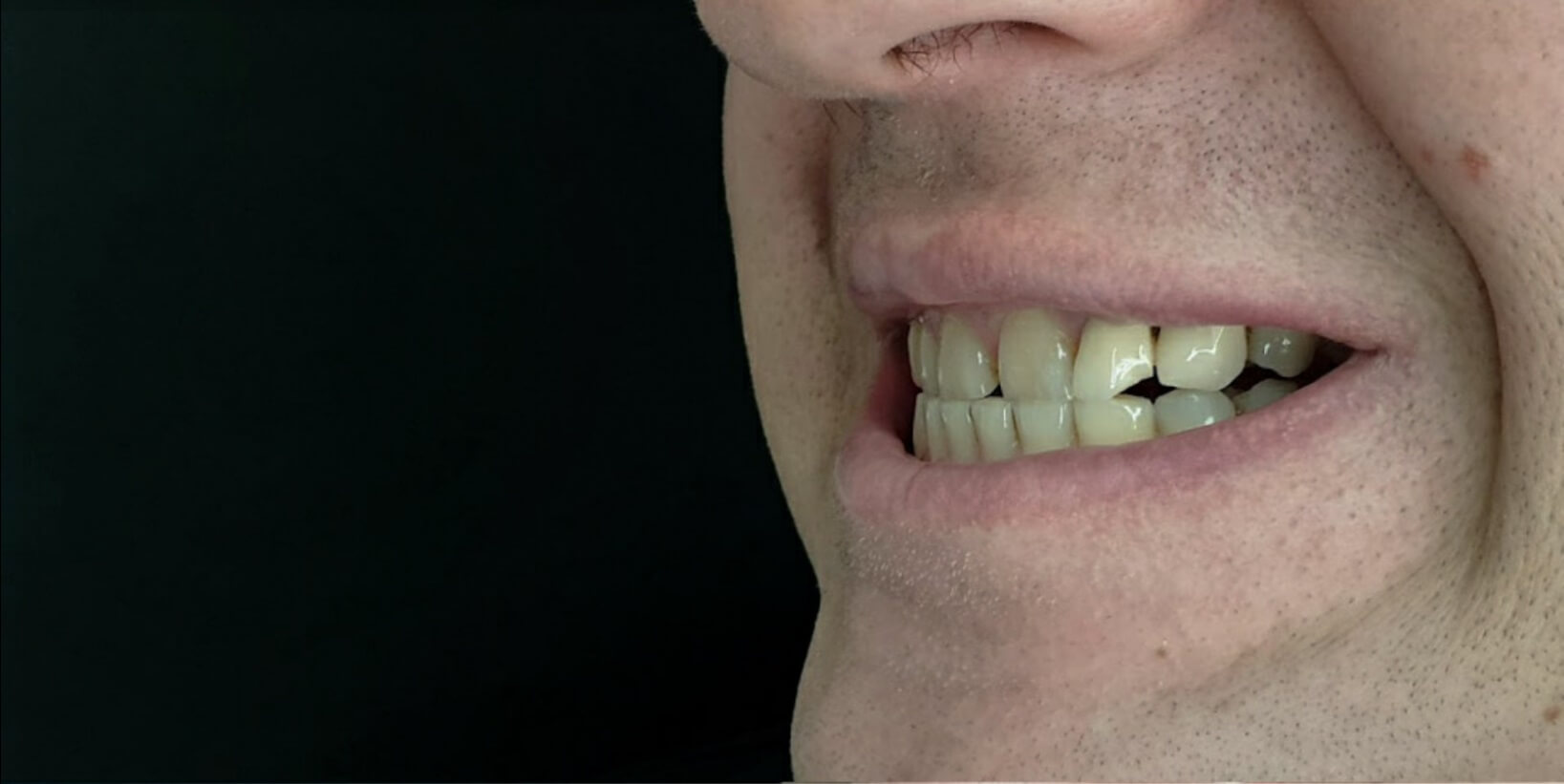Slika zuba pre keramičkih cirkona